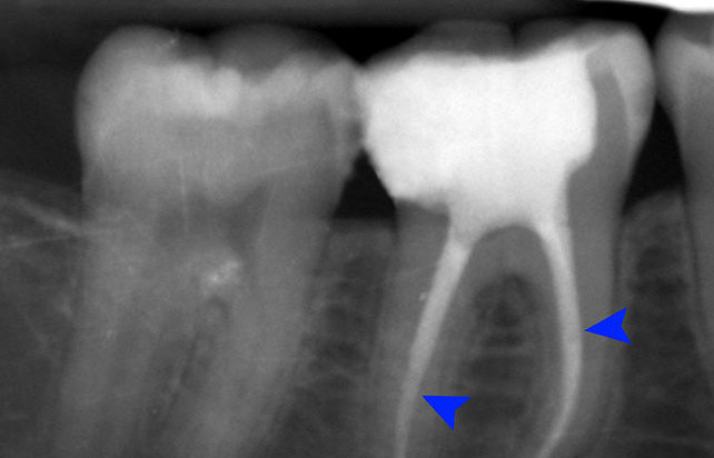 Cura Canalare - Picture by Coronation Dental Specialty Group, CC BY-SA 3.0 Cura Canalare
