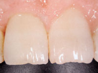 Faccette in ceramica applicate