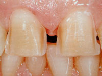 Preparazione dei denti per le faccette in ceramica