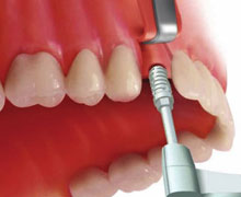 Preparazione della filettatura