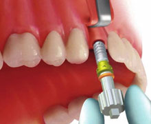 Inserimento dell'impianto