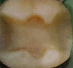 Intarsio: affinamento