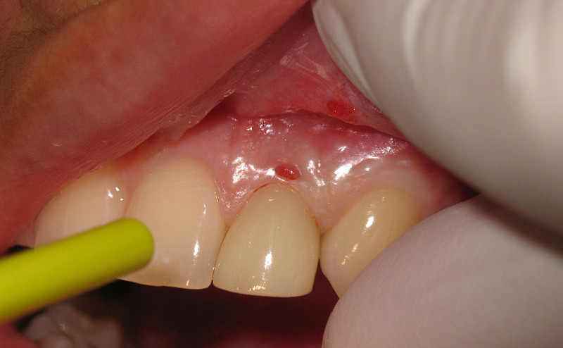 Parodontite - Picture by Dr. Dentist DDS, CC BY-SA 3.0 Parodontite