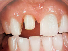 Preparazione del dente