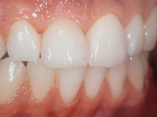 Installazione della corona