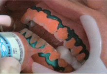 Applicazione del gel sui denti da sbiancare