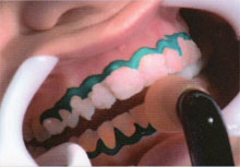 Attivazione del gel con la lampada